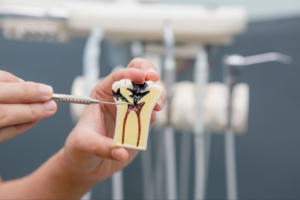 虫歯が進行している様子