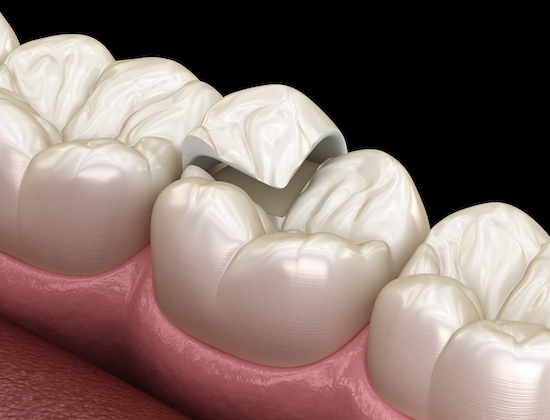 セラミック治療