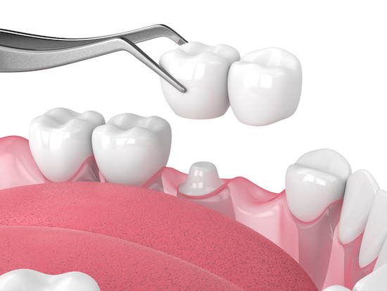 セラミックの歯