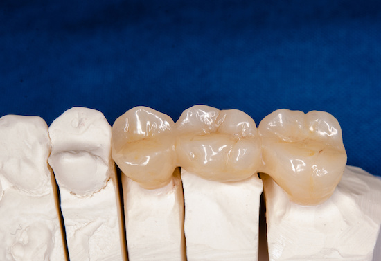 ジルコニアの詰め物イメージ