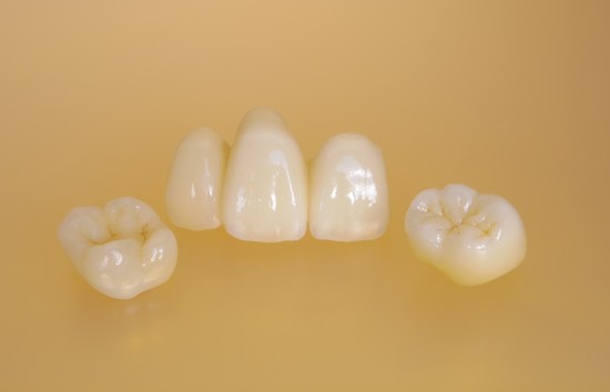 セラミックの歯