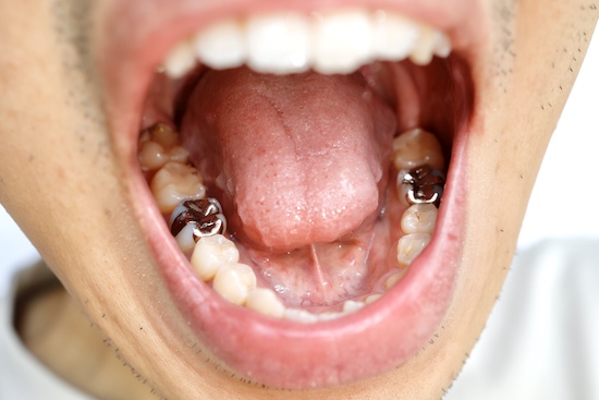 銀歯がたくさんある人