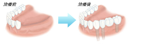 ふじみ野駅1分の歯科医院　榎本デンタルクリニック　インプラント　数本の歯が欠けている場合