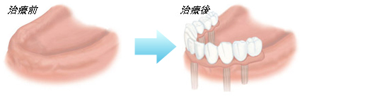 ふじみ野駅1分の歯科医院　榎本デンタルクリニック　インプラント　全ての歯が欠けている場合