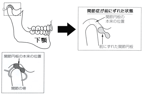 ふじみ野駅1分の歯科医院　榎本デンタルクリニック　顎関節症　顎関節症はなぜ起こるか