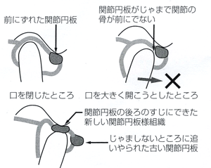 ふじみ野駅1分の歯科医院　榎本デンタルクリニック　顎関節症　顎関節症はなぜ起こるか