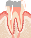 ふじみ野駅1分の歯科医院　榎本デンタルクリニック　むし歯治療　根管治療の流れ