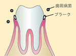 ふじみ野駅1分の歯科医院　榎本デンタルクリニック　歯周病治療　歯周病の進行状態