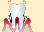 ふじみ野駅1分の歯科医院　榎本デンタルクリニック　歯周病治療　歯周病の進行状態